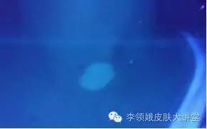 伍德灯检查淡蓝色荧光,伍德灯检查褐色荧光