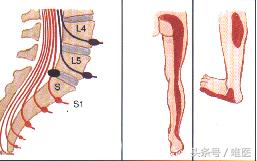 退行性腰椎管狭窄的治疗方法,腰椎管狭窄症初期症状