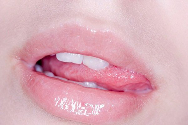 一到冬天嘴角开裂是怎么回事,冬天为什么容易烂嘴角