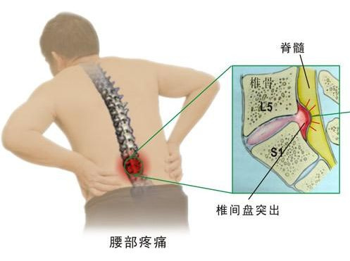 腰椎盘突出微创有效果吗,腰椎间盘4-5节突出微创手术费用