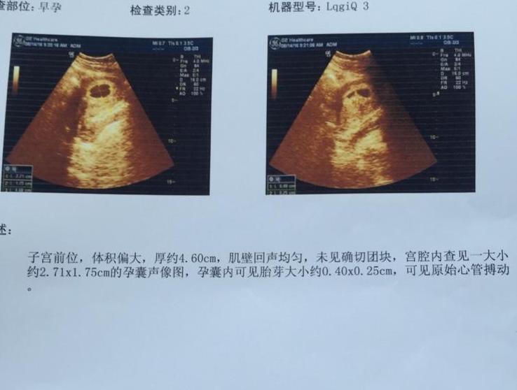 23周四维结果绕颈一圈怎么办,23周6天四维