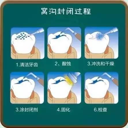 乳牙蛀了需要去拔吗,乳牙蛀了需要治疗吗