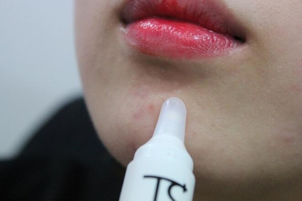 右脸长痘痘怎么治,右边脸上长痘痘怎么快速消除