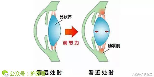 有没有成人矫正近视的办法,治近视是怎么做手术
