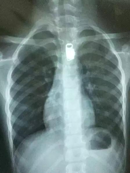 5岁男童腹部一会疼一会不痛,五岁男童肚子痛又吐是怎样情况