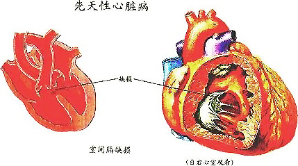 先天性心脏病常用的药物有哪些,十三味中药治疗心脏病