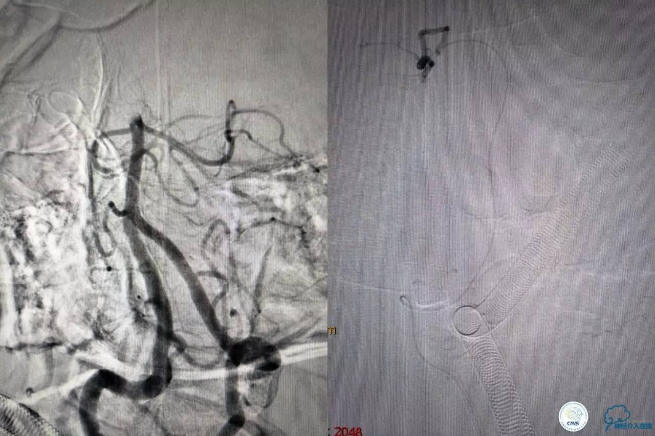 一例急性基底动脉尖综合征患者的支架取栓治疗