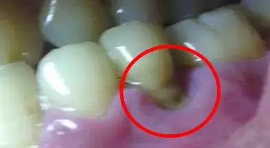 牙结石萎缩的牙龈还会恢复么,牙龈萎缩牙缝变大可以恢复吗