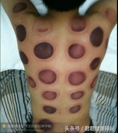 拔火罐印记是灰白颜色为什么,拔火罐的印子颜色代表了什么