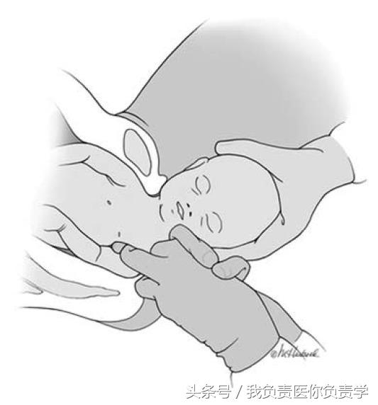 肩难产演练视频全部过程,产妇出现肩难产视频