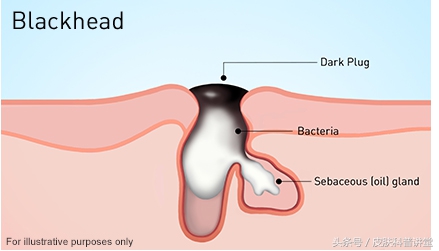 皮肤科医生毛孔粗大推荐的护肤品,毛孔粗大有黑头可以看皮肤科吗