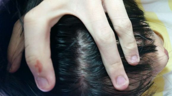 头皮屑脂溢性皮炎中药疗法,头皮脂溢性皮炎中医治疗