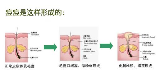 有什么方法祛痘有效最快,如何祛痘痘最有效的方法教给你