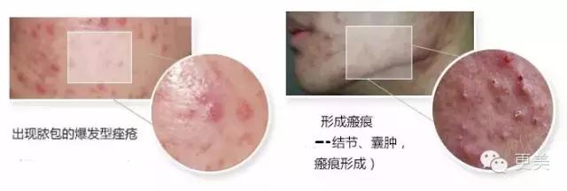 长痘痘好焦虑啊,长痘痘要用什么药治疗