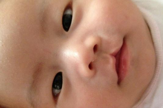 新生儿腭裂1度怎么治疗,腭裂语言矫正训练有效的办法