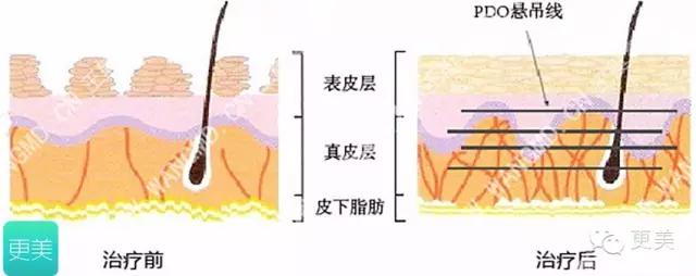青春定格？4D埋线？音波拉皮？别晕，面部提升就那老三样