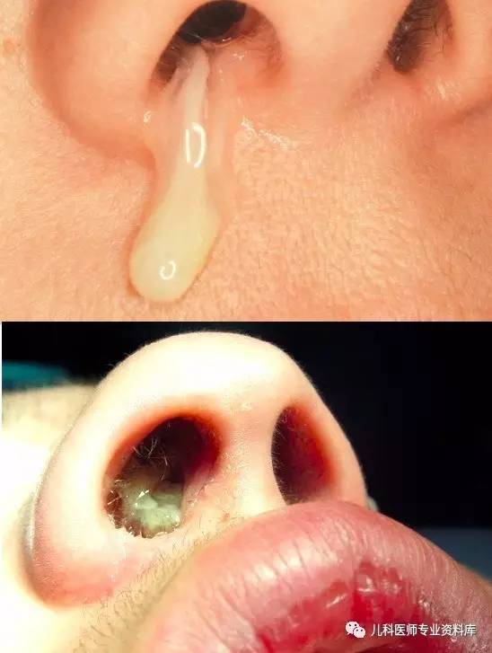 儿童鼻涕的秘密,儿童黄鼻涕粘稠