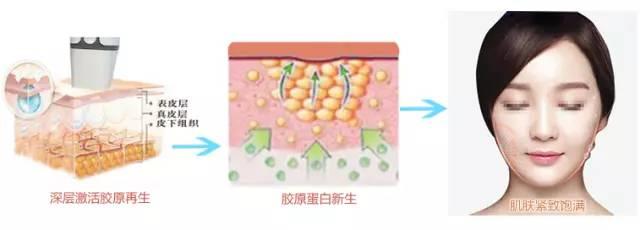 超声刀后必须吃修复型胶原蛋白吗,做完超声炮怎么补充胶原蛋白