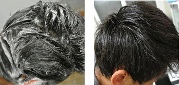 严重脱发掉头发怎么办,女人头顶脱发厉害是什么原因