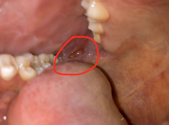 口腔溃疡永不复发这里来支小妙招！