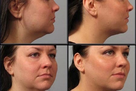 做过超声刀的真实体会,做超声刀后的真实效果