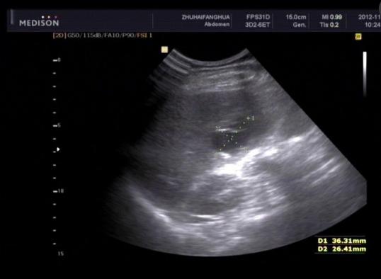 胃穿孔真的是胃上出现洞了吗,胃穿孔是腹部慢慢变硬吗