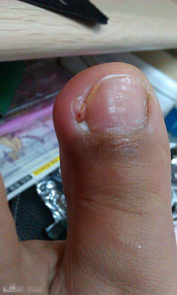 甲沟炎塞棉花法管用吗,甲沟炎塞棉花视频教程