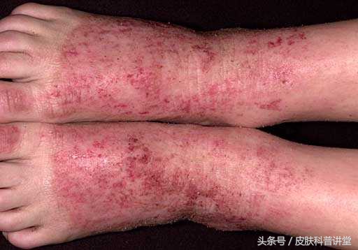 反复过敏要警惕,反复过敏但测过敏源不过敏