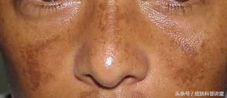 突然长了褐色的斑是怎么回事,突然长斑了怎么办