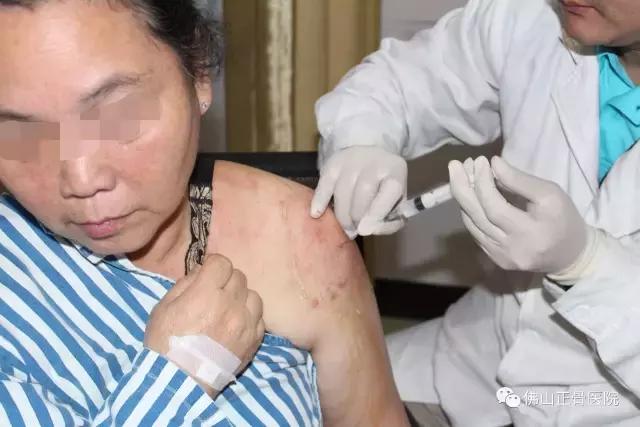 肌骨康复治疗技术讲解视频,康复学堂肩袖损伤康复训练