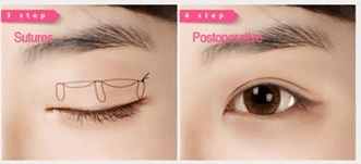 埋线双眼皮的正确操作手法,埋线双眼皮很浅