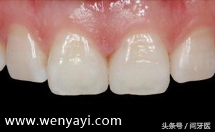 门牙有缝的女人有什么不好,门牙有缝怎么办如何补救