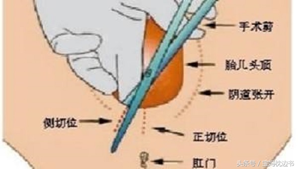 打算顺产的孕妈应该知道关于侧切的9个问题