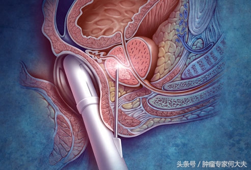 前列腺癌晚期贫血腿肿怎么办,前列腺癌晚期一侧腿肿怎么办
