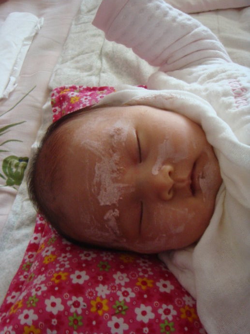 宝宝湿疹了可以擦面霜吗,宝宝湿疹了怎么办