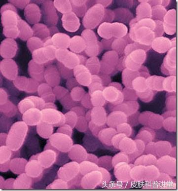 一张图教你辨别脓疱疮,皮肤科普直播