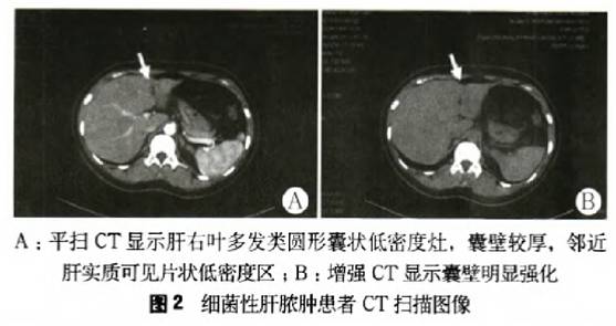 病检嗜酸性粒细胞增多提示啥病,嗜酸性粒细胞升高并且腹痛