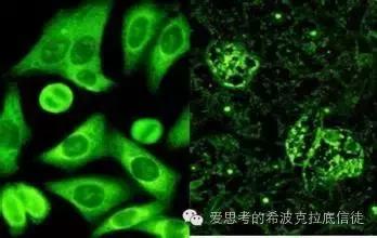 是治疗红斑狼疮，还是治疗抗核抗体？