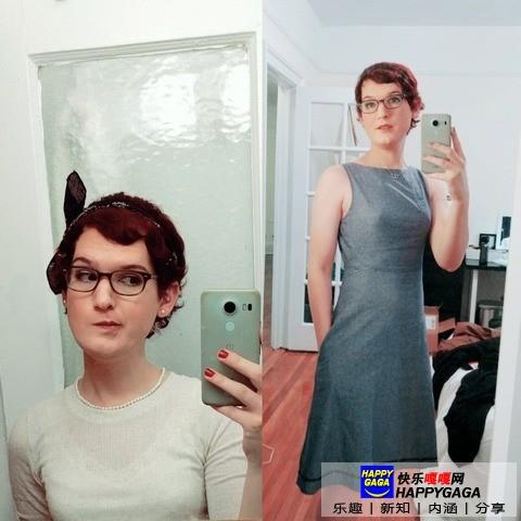 雌激素治脱发,雄性激素脱发补充雌性激素有用吗