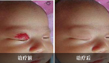 毛细血管瘤的形成原因,婴儿毛细血管瘤的原因