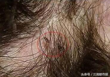 8岁女孩头皮痒老抓怎么办,8岁女孩子头皮特别痒有头皮屑