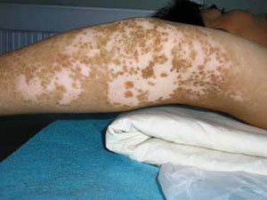 白癜风吃啥有助于治疗,白癜风应该注意什么饮食