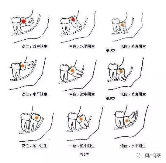 拔智齿瘦了20斤,拔完智齿变成了瓜子脸