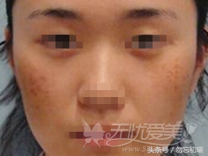 身体上褐斑对应的病症,褐青色斑是身体哪里出了问题