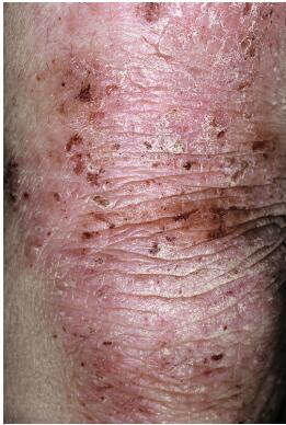 孩子湿疹最佳图片,孩子面部湿疹