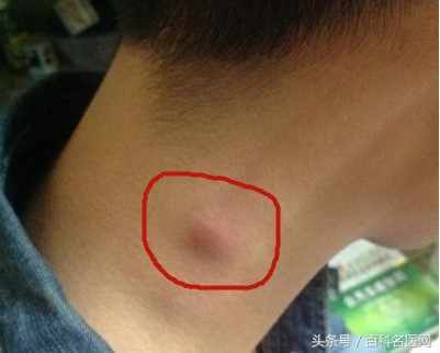 颈部淋巴结肿大警惕鼻咽癌,颈部淋巴结突然肿大是淋巴癌吗