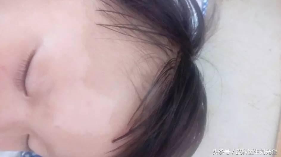 胎记按病因分为几类,胎记的原因及解决方法