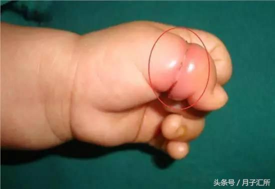 妈妈的头发，竟成宝宝“缠绕伤”的罪魁祸首！