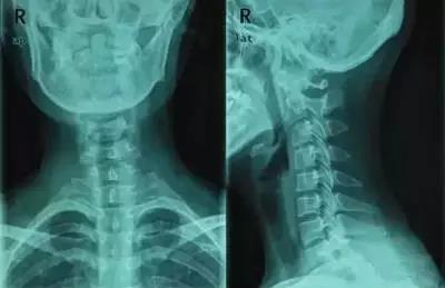 躺酒瓶治疗颈椎病是真的吗,颈椎病用酒瓶枕头能治好吗