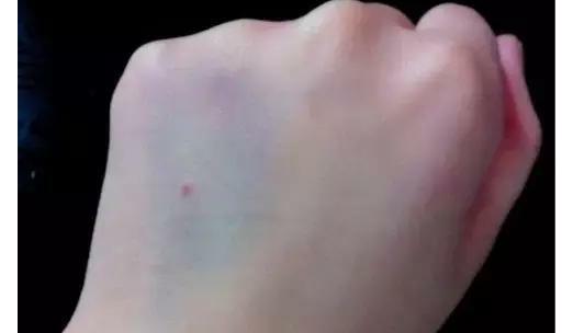 女生输液手背很多针眼和淤青图片,输液几天后手背出现淤青